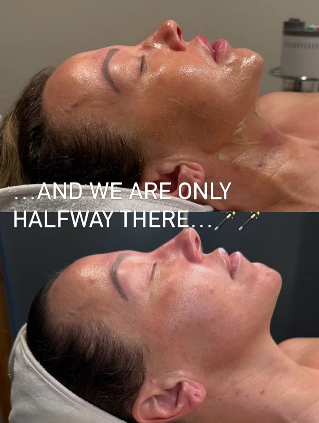 MLAesthetics treatment before and after result