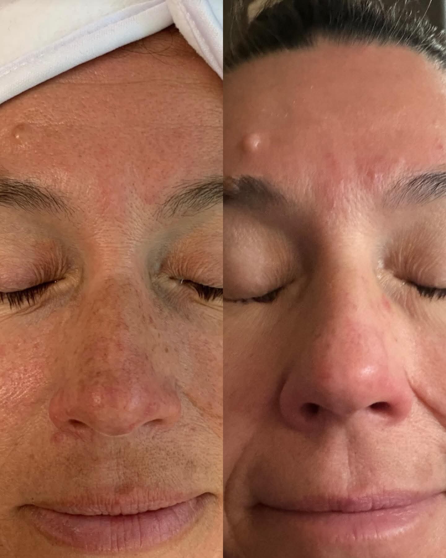 MLAesthetics skincare before and after result