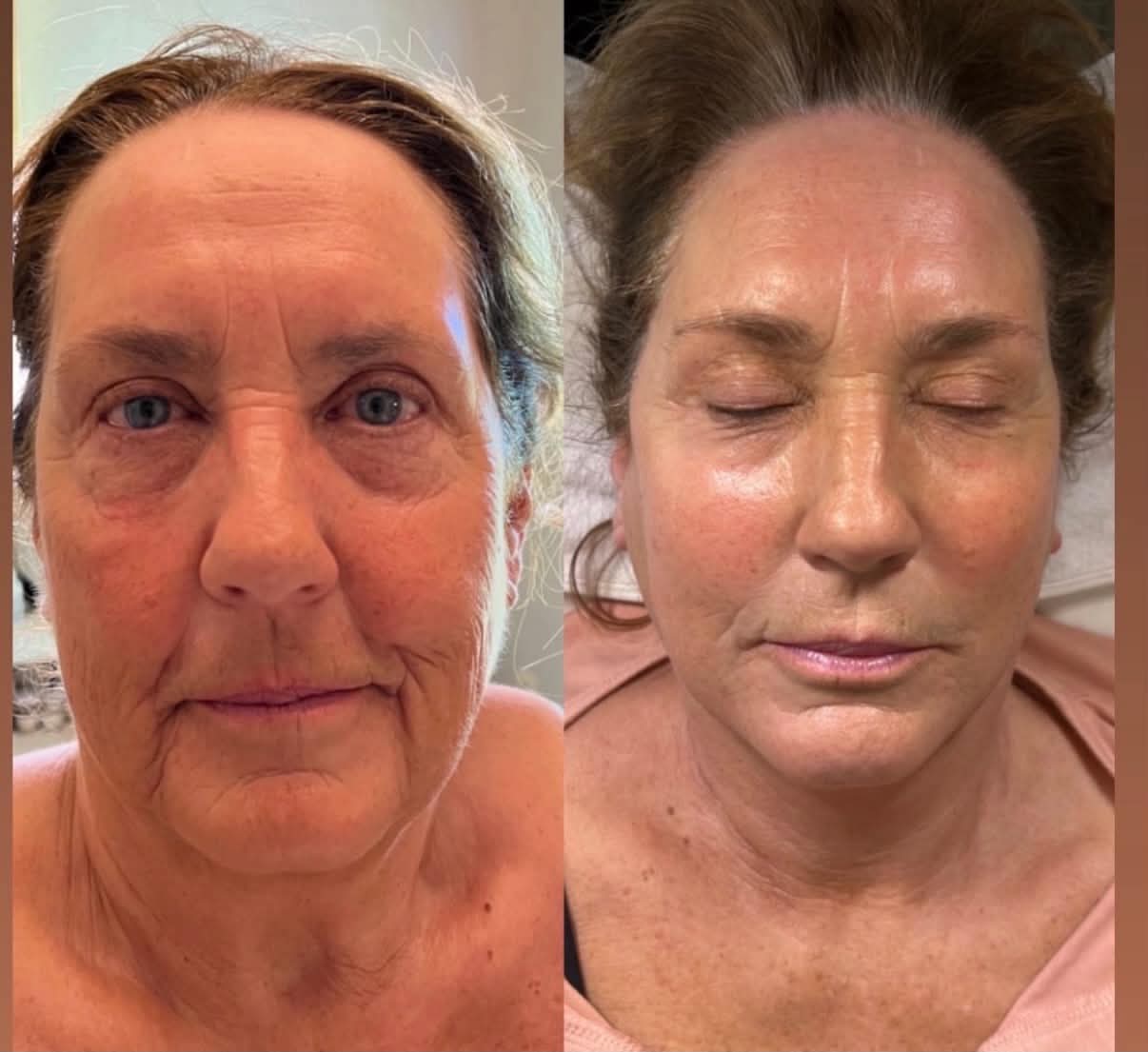 MLAesthetics client before and after result