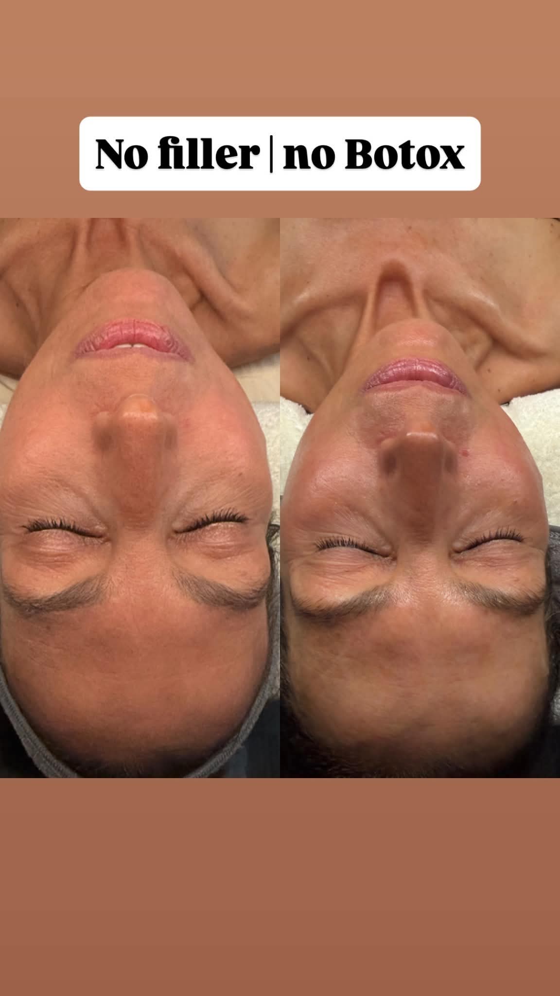 MLAesthetics client before and after skincare result